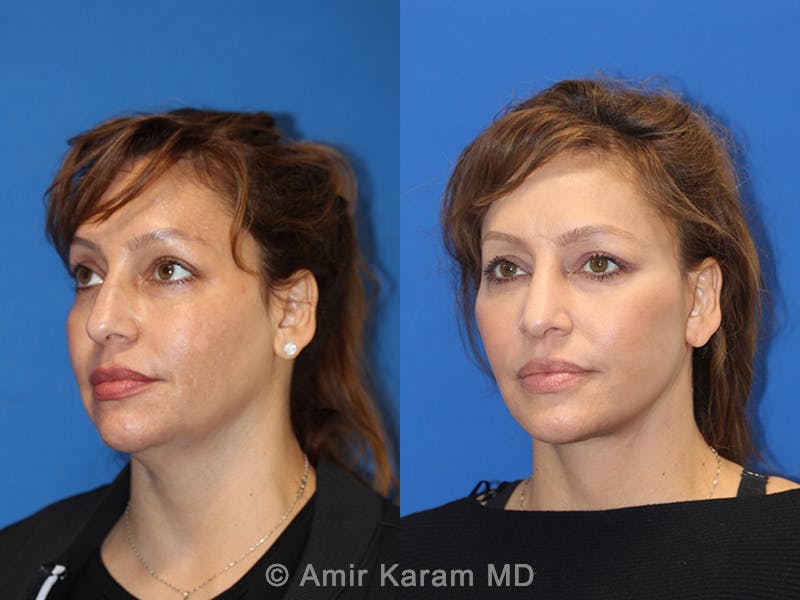 Vertical Restore® / Facial Rejuvenation Before & After Gallery - Patient 71700609 - Image 3