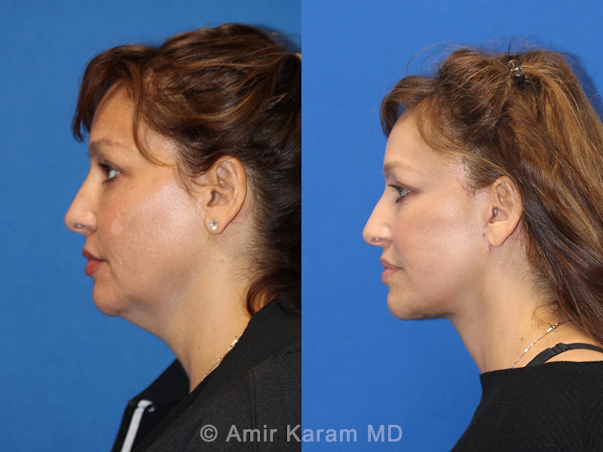 Vertical Restore® / Facial Rejuvenation Before & After Gallery - Patient 71700609 - Image 4