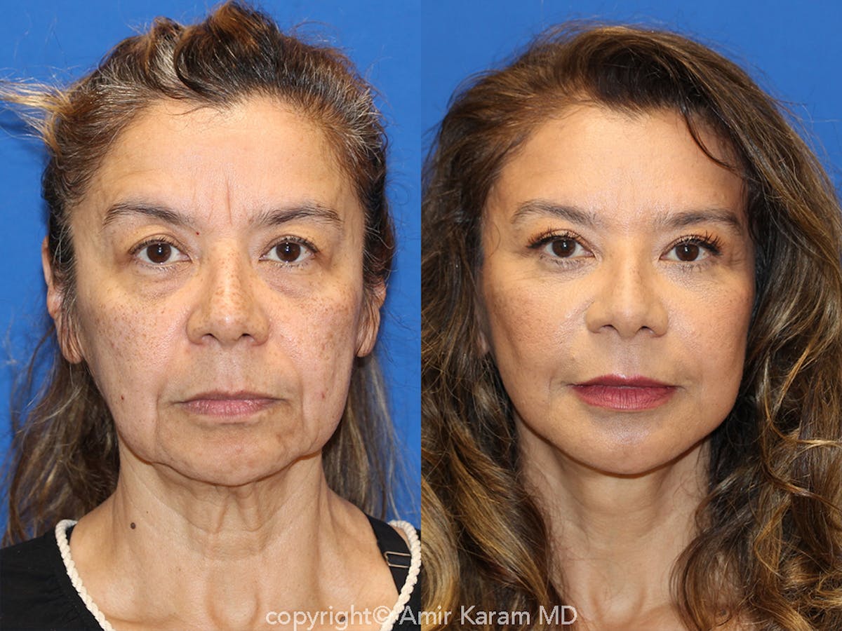 Vertical Restore® / Facial Rejuvenation Before & After Gallery - Patient 71700612 - Image 1
