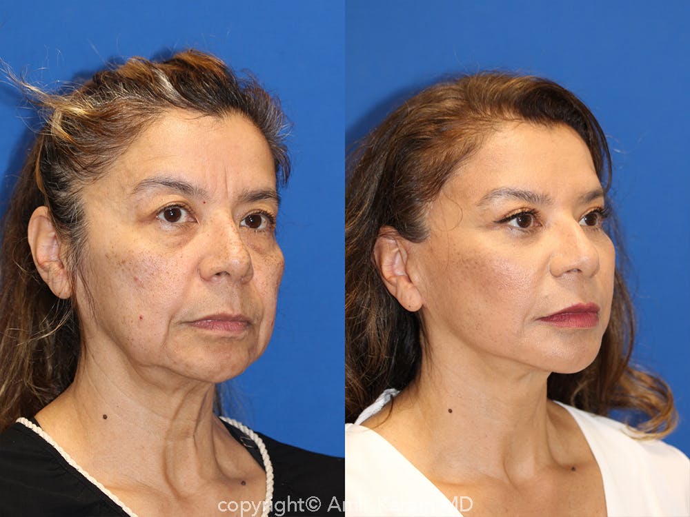 Vertical Restore® / Facial Rejuvenation Before & After Gallery - Patient 71700612 - Image 2