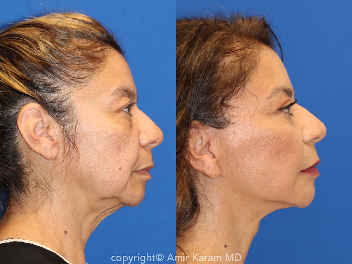 Vertical Restore® / Facial Rejuvenation Before & After Gallery - Patient 71700612 - Image 3