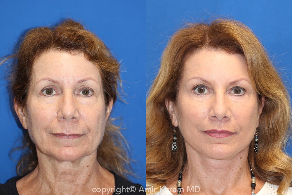 Vertical Restore® / Facial Rejuvenation Before & After Gallery - Patient 71700624 - Image 1