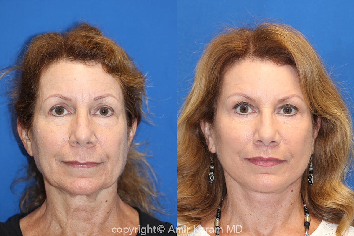 Fat Transfer Before & After Gallery - Patient 89289954 - Image 1