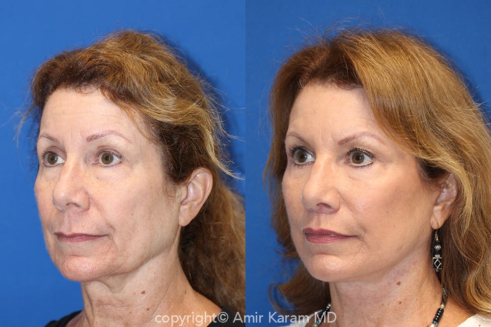 Vertical Restore® / Facial Rejuvenation Before & After Gallery - Patient 71700624 - Image 2