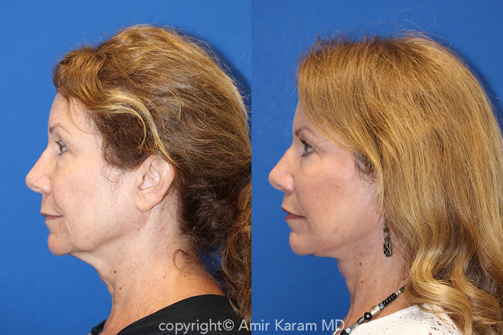Vertical Restore® / Facial Rejuvenation Before & After Gallery - Patient 71700624 - Image 3