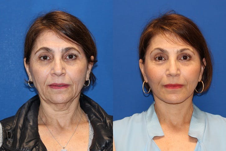 Vertical Restore® / Facial Rejuvenation Before & After Gallery - Patient 71700629 - Image 1