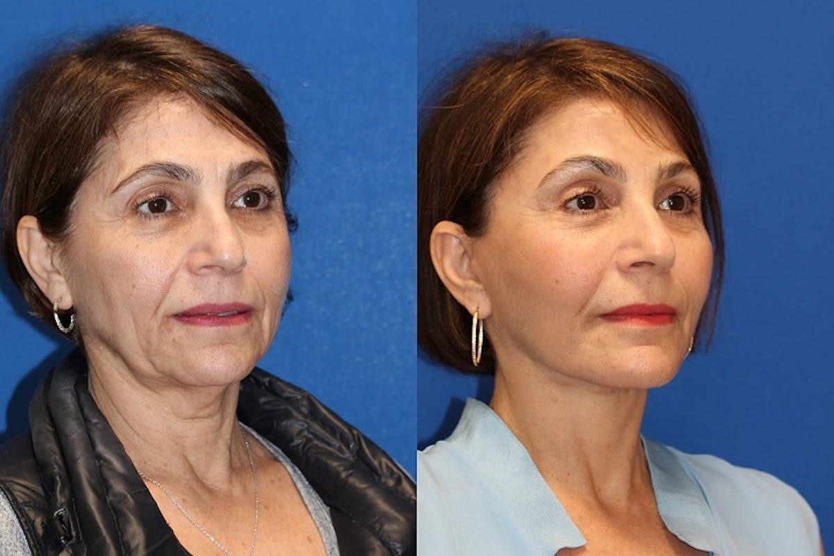 Vertical Restore® / Facial Rejuvenation Before & After Gallery - Patient 71700629 - Image 2