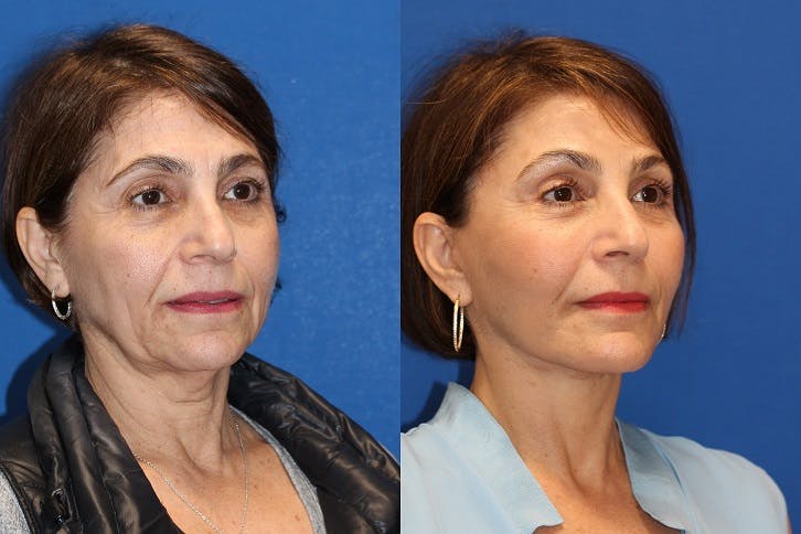 Vertical Restore® / Facial Rejuvenation Before & After Gallery - Patient 71700629 - Image 2