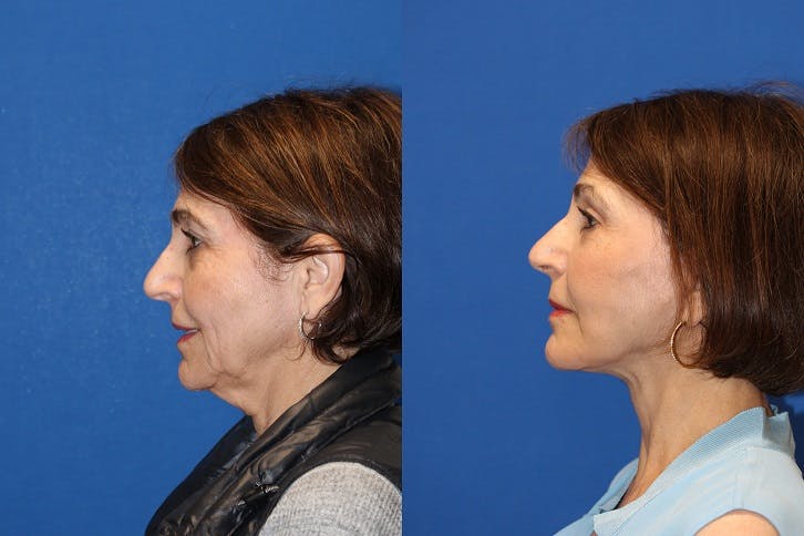 Vertical Restore® / Facial Rejuvenation Before & After Gallery - Patient 71700629 - Image 3