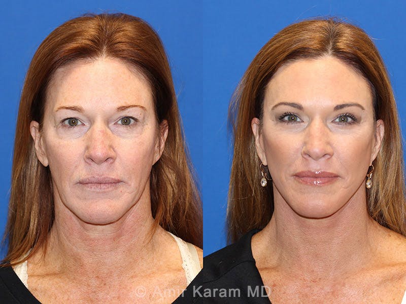 Vertical Restore® / Facial Rejuvenation Before & After Gallery - Patient 71700632 - Image 1