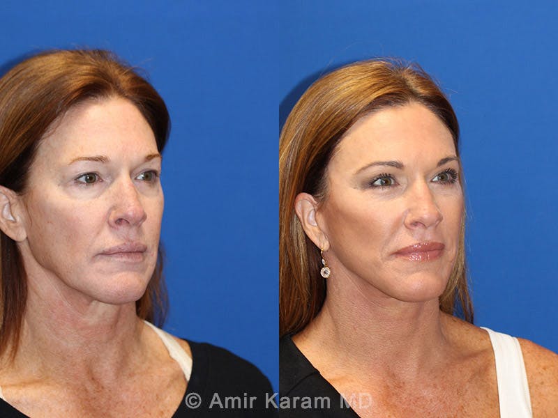 Vertical Restore® / Facial Rejuvenation Before & After Gallery - Patient 71700632 - Image 2