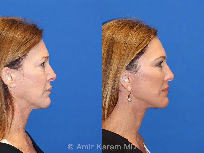 Vertical Restore® / Facial Rejuvenation Before & After Gallery - Patient 71700632 - Image 3