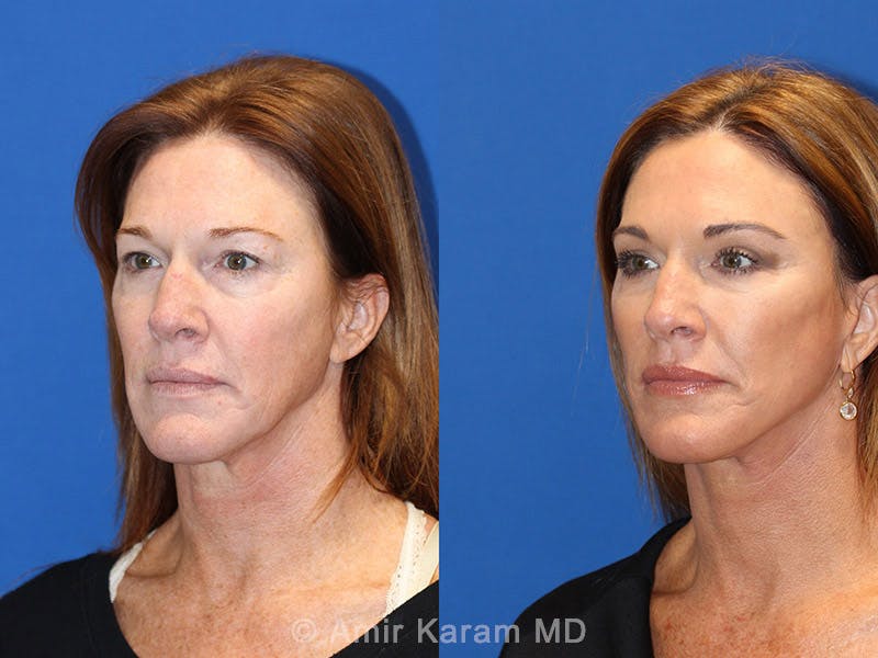 Vertical Restore® / Facial Rejuvenation Before & After Gallery - Patient 71700632 - Image 4