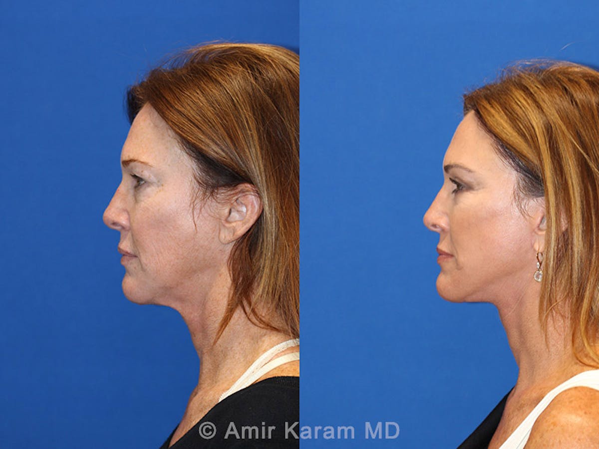 Vertical Restore® / Facial Rejuvenation Before & After Gallery - Patient 71700632 - Image 5