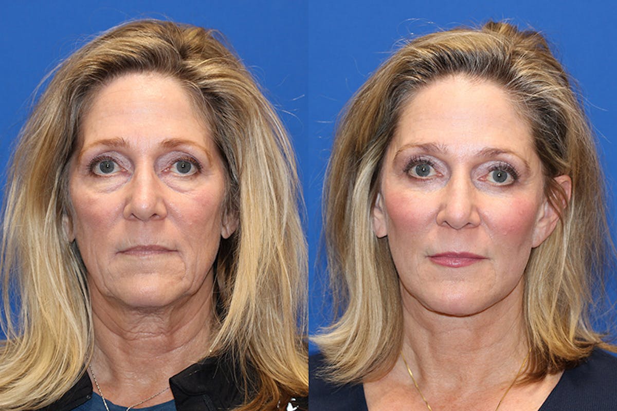 Vertical Restore® / Facial Rejuvenation Before & After Gallery - Patient 71700634 - Image 1