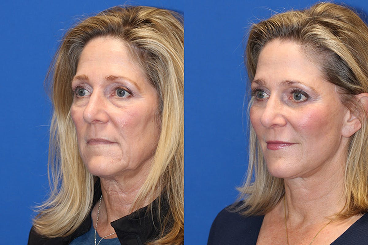 Vertical Restore® / Facial Rejuvenation Before & After Gallery - Patient 71700634 - Image 2