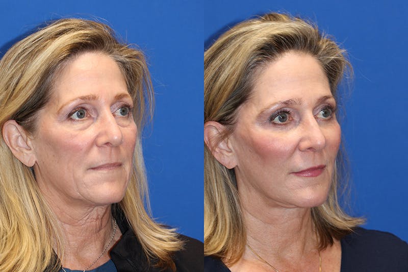 Vertical Restore® / Facial Rejuvenation Before & After Gallery - Patient 71700634 - Image 3