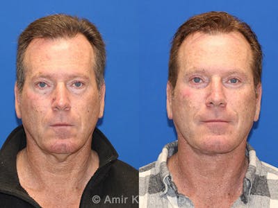 Vertical Restore® / Facial Rejuvenation Before & After Gallery - Patient 71700635 - Image 1