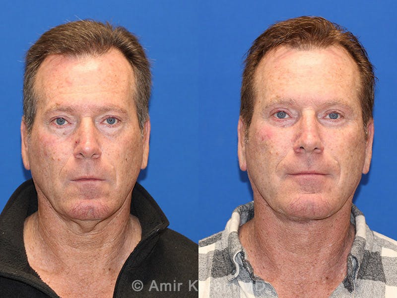 Vertical Restore® / Facial Rejuvenation Before & After Gallery - Patient 71700635 - Image 1