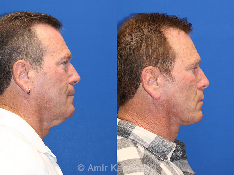 Patient 71700635 Vertical Restore® / Facial Rejuvenation Before