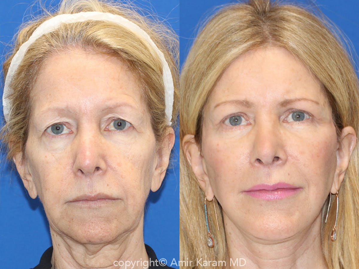 Vertical Restore® / Facial Rejuvenation Before & After Gallery - Patient 71700638 - Image 1