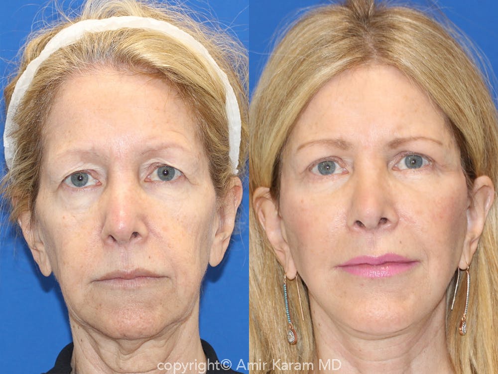 Vertical Restore® / Facial Rejuvenation Before & After Gallery - Patient 71700638 - Image 1