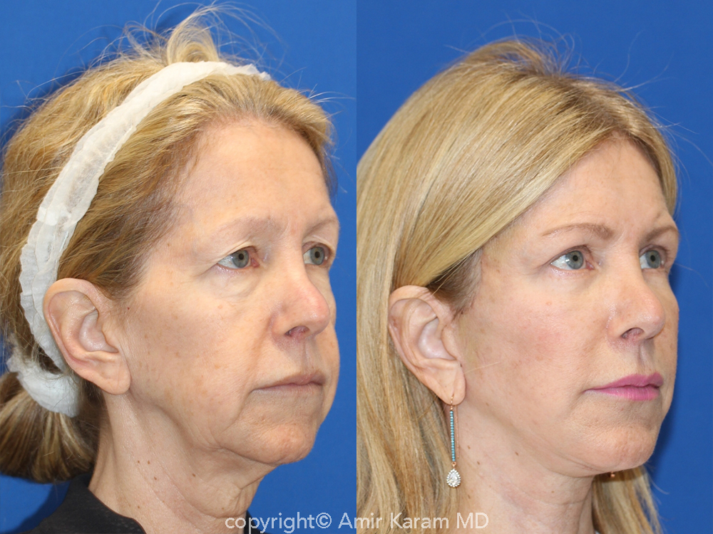 Patient 71700638 Vertical Restore® / Facial Rejuvenation Before