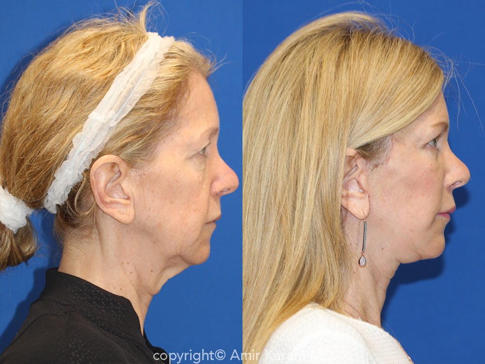 Vertical Restore® / Facial Rejuvenation Before & After Gallery - Patient 71700638 - Image 3