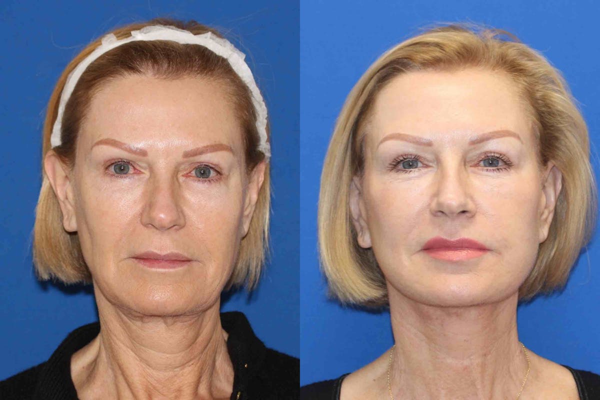 Vertical Restore® / Facial Rejuvenation Before & After Gallery - Patient 71700640 - Image 1