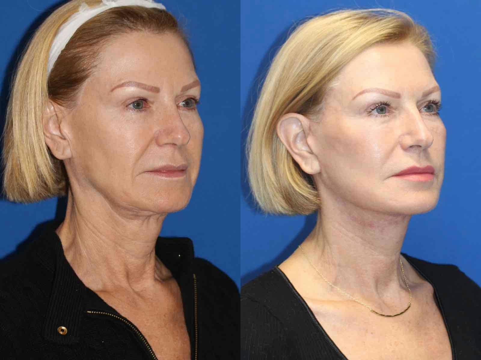 Vertical Restore® / Facial Rejuvenation Before & After Gallery - Patient 71700640 - Image 2