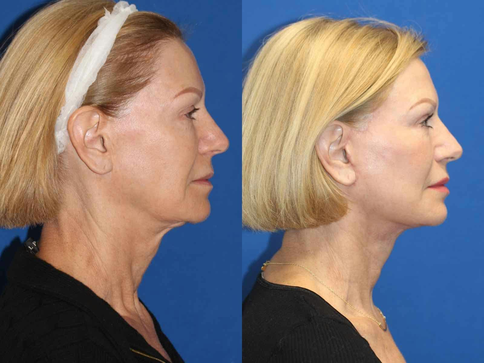 Vertical Restore® / Facial Rejuvenation Before & After Gallery - Patient 71700640 - Image 3
