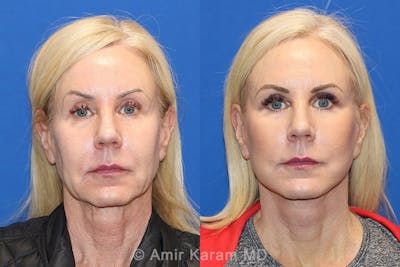 Vertical Restore® / Facial Rejuvenation Before & After Gallery - Patient 71700644 - Image 1