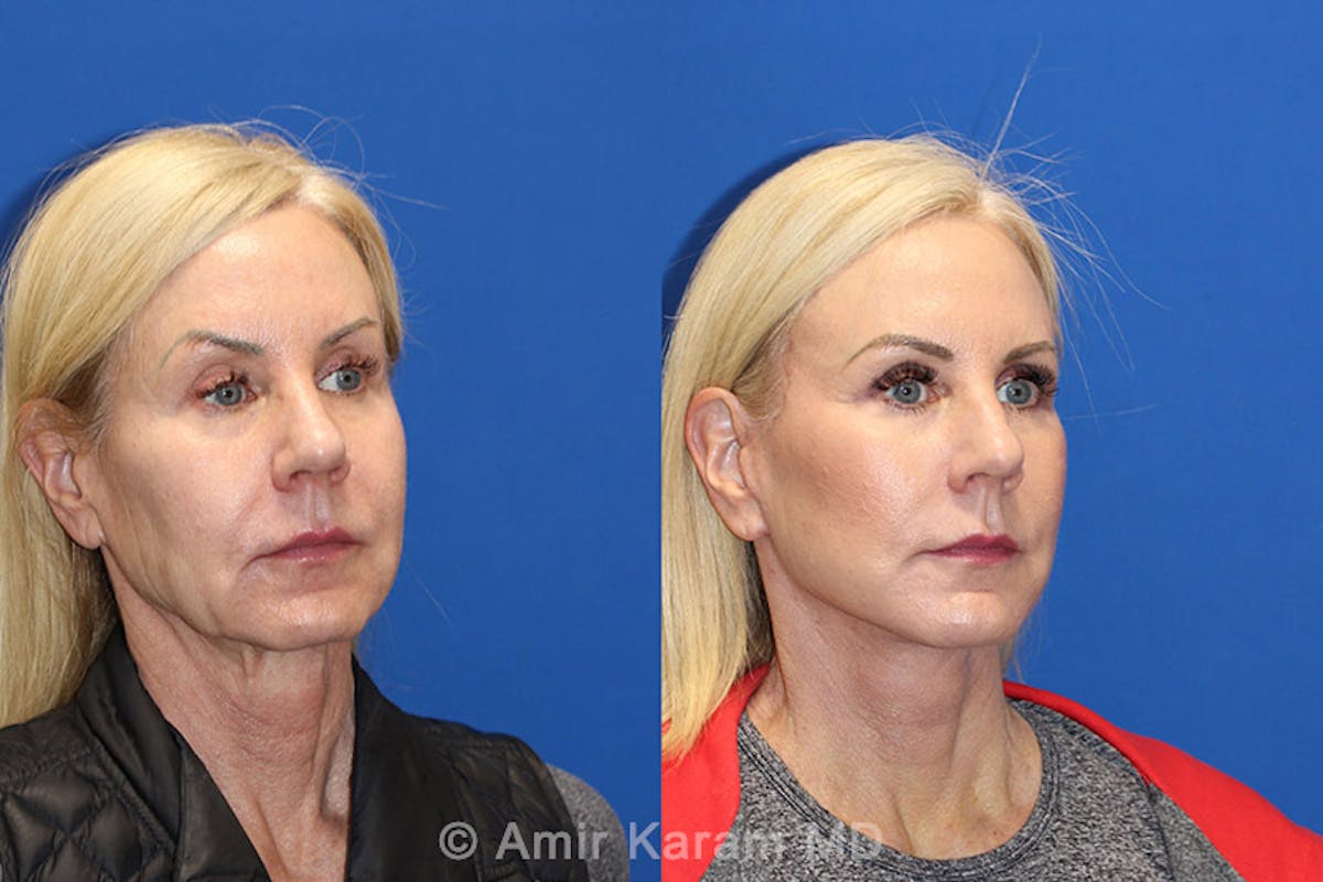 Vertical Restore® / Facial Rejuvenation Before & After Gallery - Patient 71700644 - Image 2