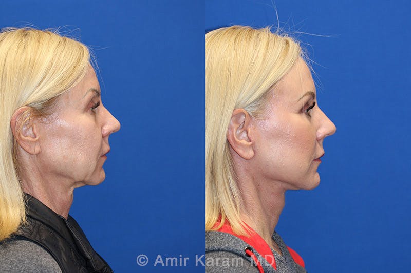Vertical Restore® / Facial Rejuvenation Before & After Gallery - Patient 71700644 - Image 3