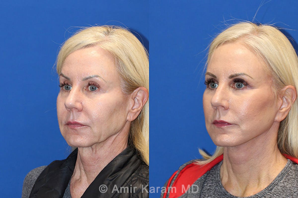 Vertical Restore® / Facial Rejuvenation Before & After Gallery - Patient 71700644 - Image 4