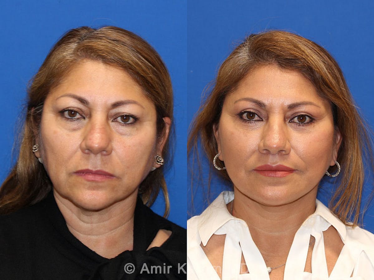 Vertical Restore® / Facial Rejuvenation Before & After Gallery - Patient 71700648 - Image 1