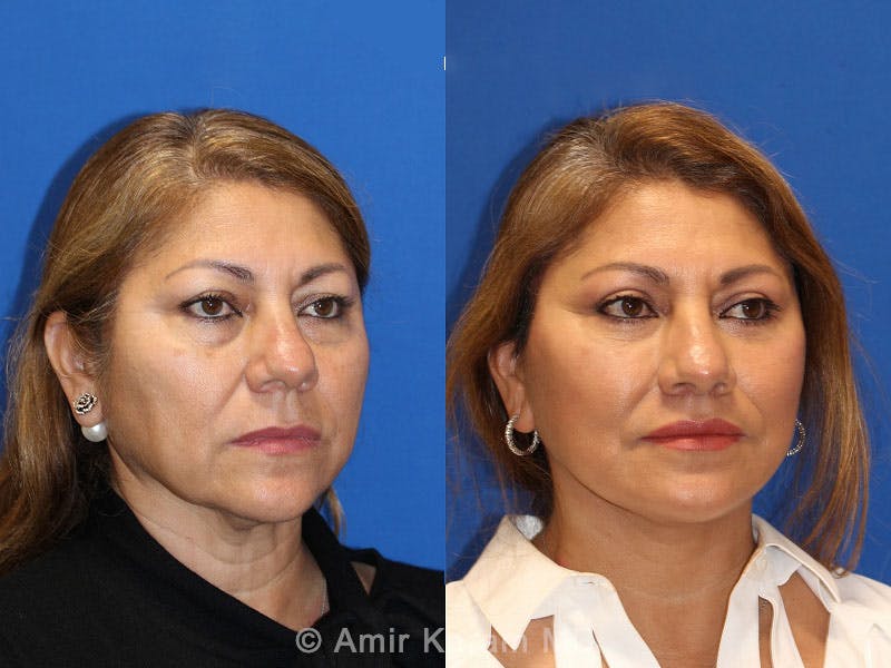 Vertical Restore® / Facial Rejuvenation Before & After Gallery - Patient 71700648 - Image 2