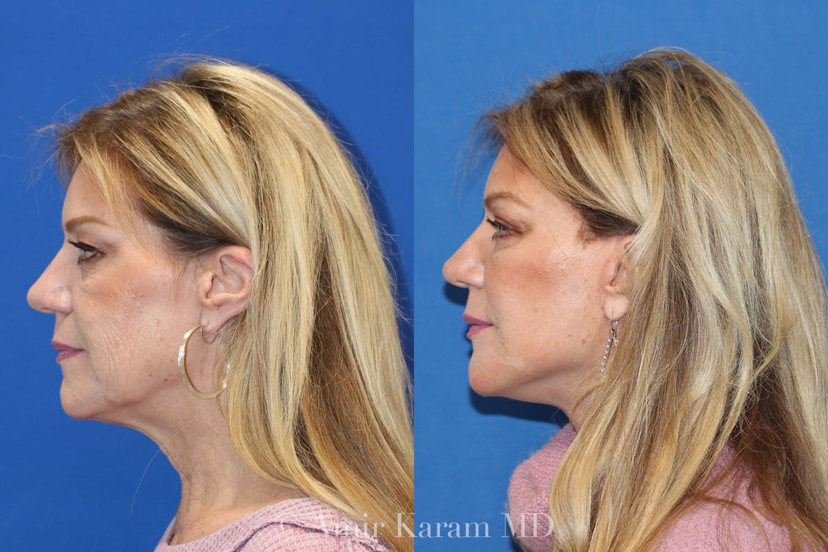 Fat Transfer Before & After Gallery - Patient 71700650 - Image 2