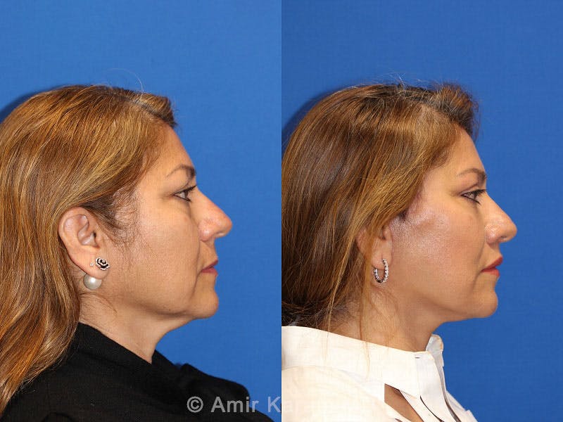 Vertical Restore® / Facial Rejuvenation Before & After Gallery - Patient 71700648 - Image 3
