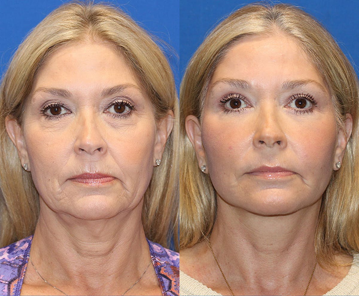 Vertical Restore® / Facial Rejuvenation Before & After Gallery - Patient 71700653 - Image 1