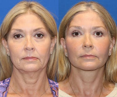 Vertical Restore® / Facial Rejuvenation Before & After Gallery - Patient 71700653 - Image 1