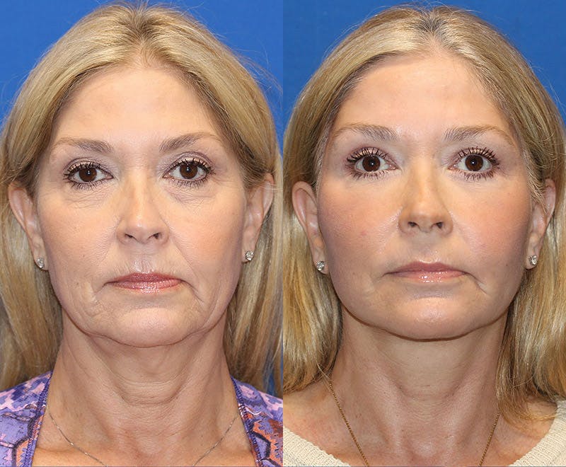 Vertical Restore® / Facial Rejuvenation Gallery - Patient 71700653 - Image 1