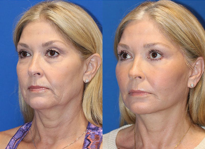 Vertical Restore® / Facial Rejuvenation Before & After Gallery - Patient 71700653 - Image 2