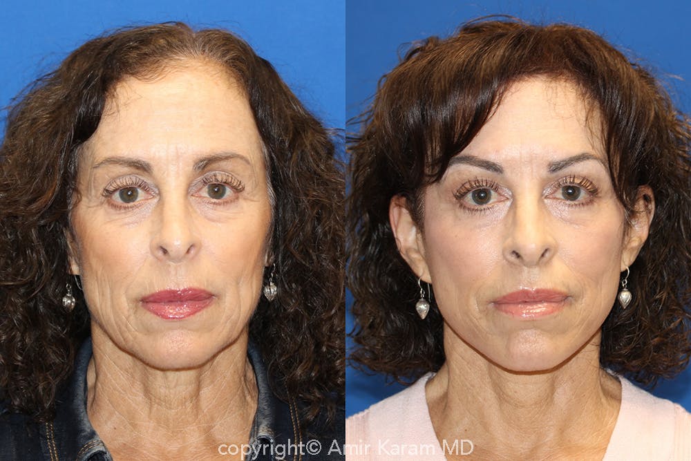 Vertical Restore® / Facial Rejuvenation Before & After Gallery - Patient 71700656 - Image 1