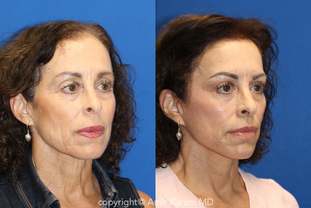 Vertical Restore® / Facial Rejuvenation Before & After Gallery - Patient 71700656 - Image 2