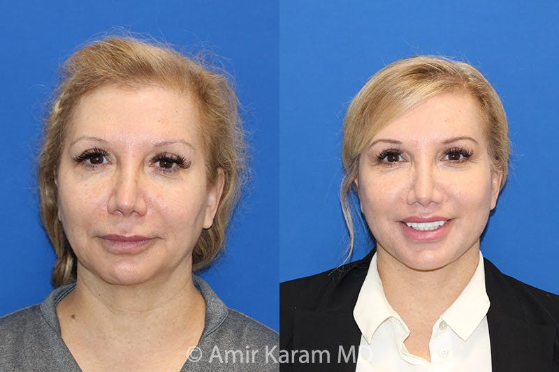Lip Lift Before & After Gallery - Patient 71700657 - Image 1