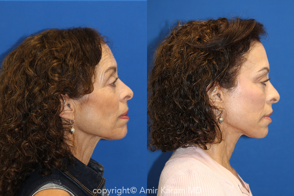 Patient 71700656 Vertical Restore® / Facial Rejuvenation Before