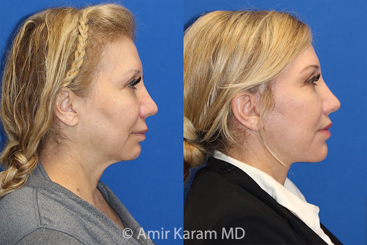 Lip Lift Before & After Gallery - Patient 71700657 - Image 2