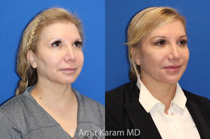 Lip Lift Before & After Gallery - Patient 71700657 - Image 3
