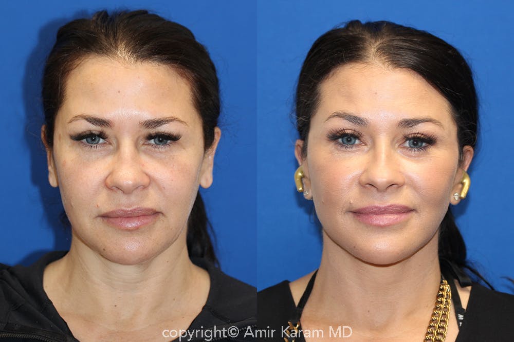 Vertical Restore® / Facial Rejuvenation Before & After Gallery - Patient 71700661 - Image 1